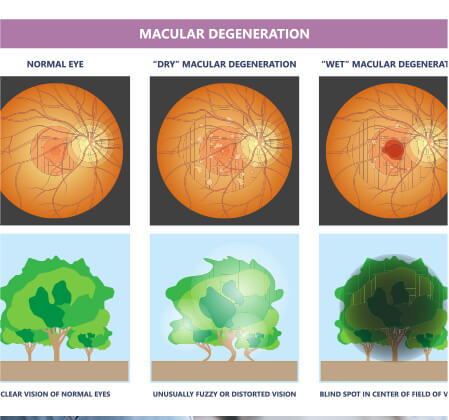Graphic of macular degeneration